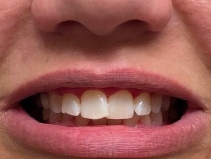 Brittany's teeth after the 7-day Luxissimo protocol