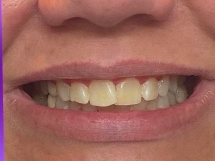 Brittany's teeth before the 7-day Luxissimo protocol